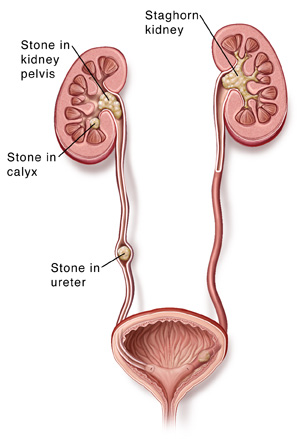 Crossection of kidneys, ureter, and bladder. Kidney stones can accumulate in the kidneys and in the ureter.