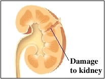 hematuria damaged kidney