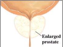 hematuria enlarged prostate