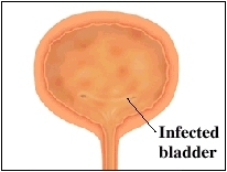 hematuria infected bladder