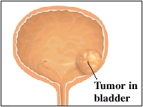 hematuria tumor in bladder