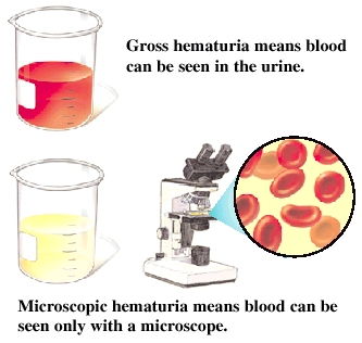 what is hematuria